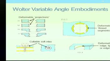 AngleFix Tech, LLC v. Smith &amp; Nephew, Inc (Part 2)